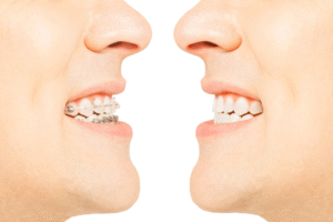 Read more about the article Straighten Up and Smile: Clear Aligners vs. Braces – All Smiles Has the Answer!