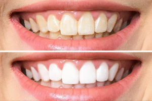 Read more about the article Whiter Than White: Secrets to a Radiant Smile