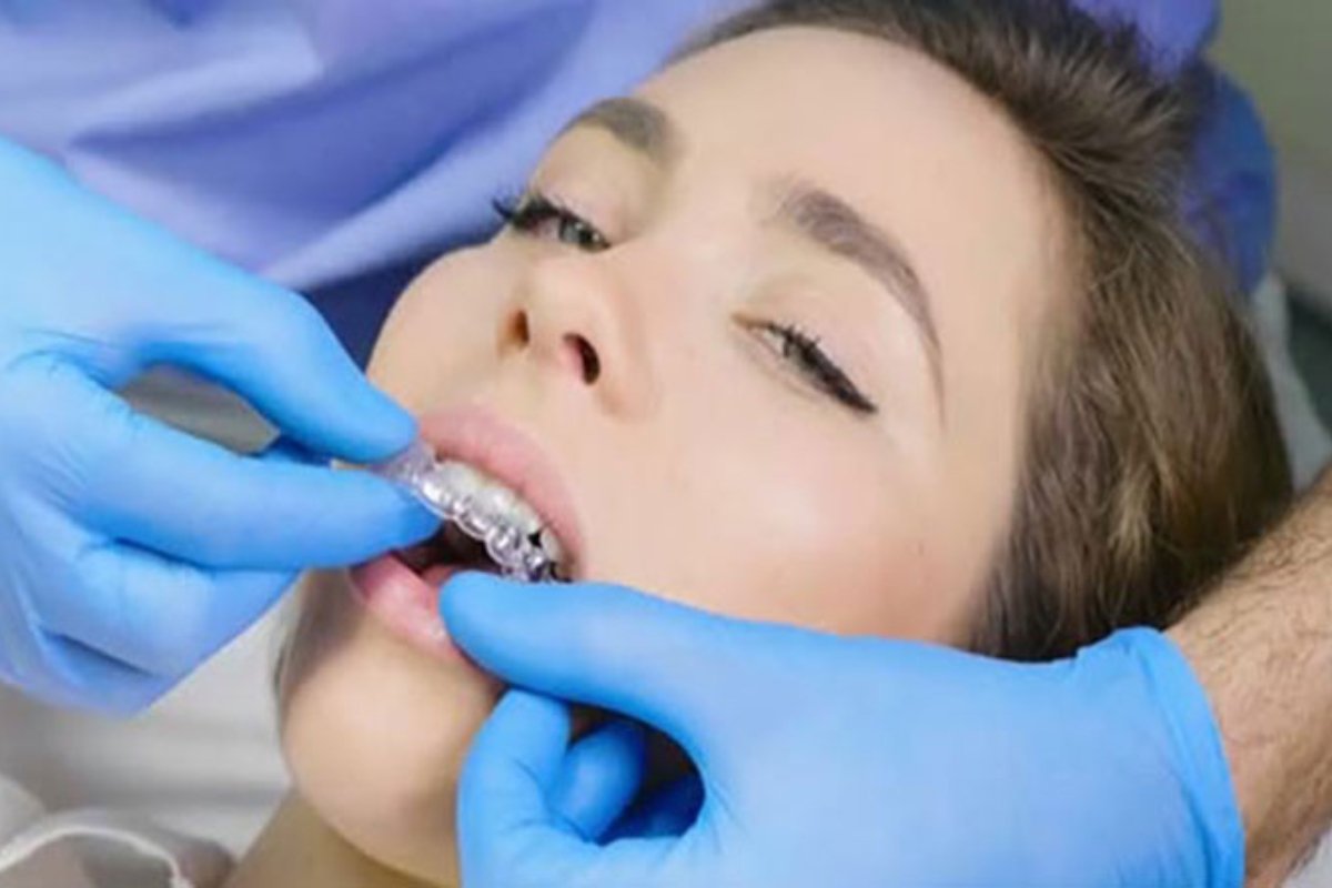 Clear aligner fitting in Langwarrin dental clinic