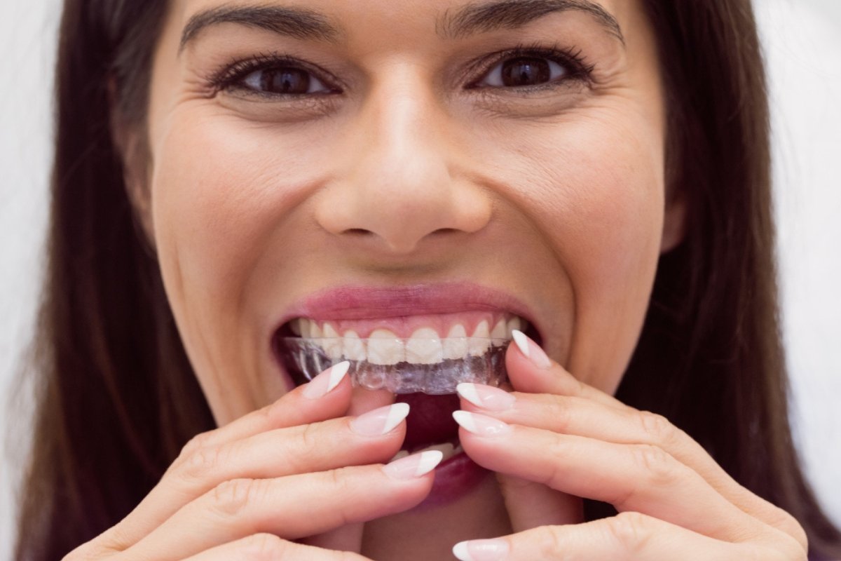 Invisalign aligner fitting at dental clinic in Ashburton