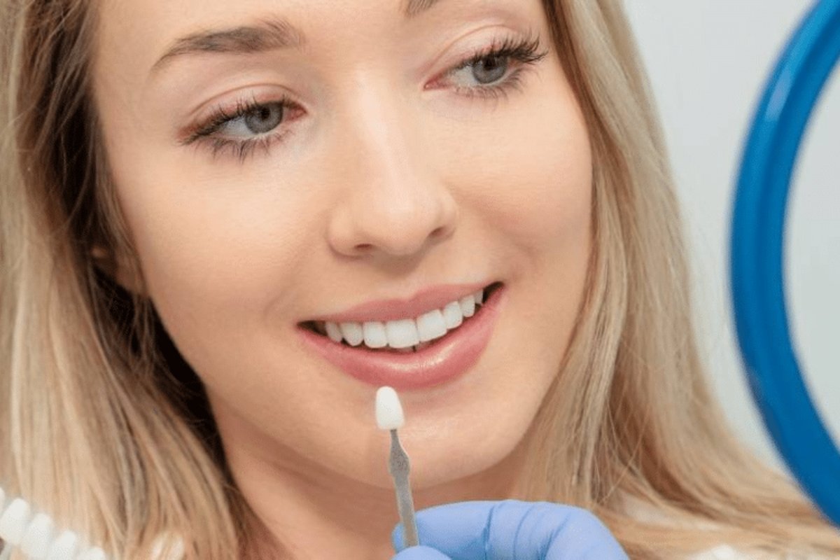 Veneers procedure at dental clinic near Bentleigh