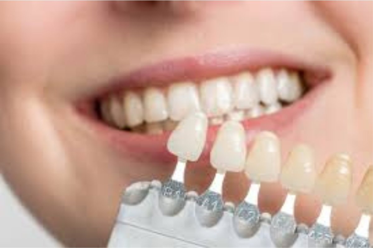 Patient getting veneers treatment near Toorak