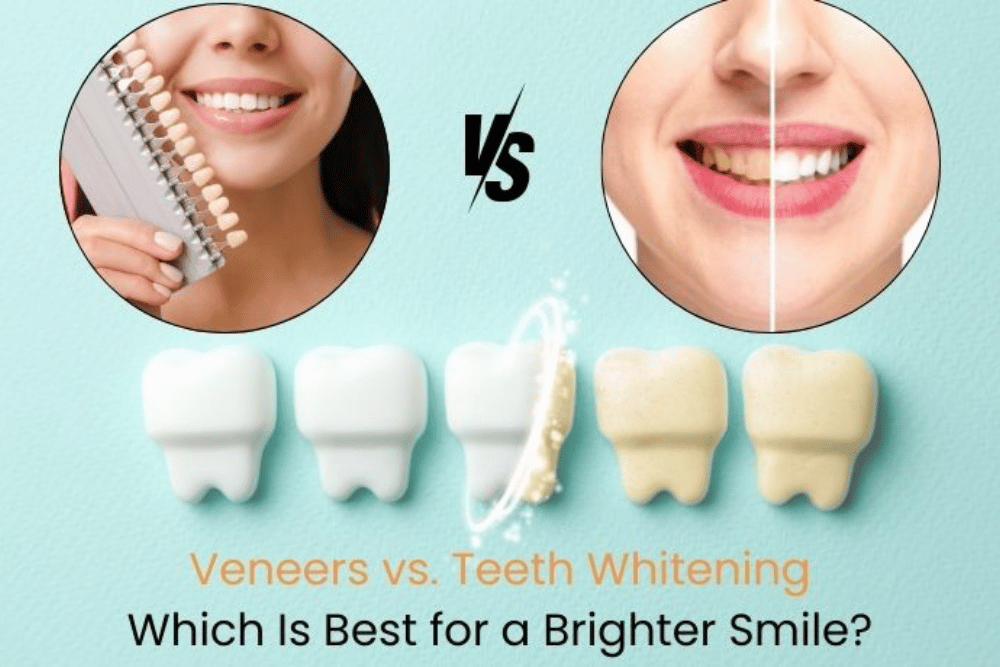 You are currently viewing Veneers vs. Whitening: Which Smile Fix Wins?
