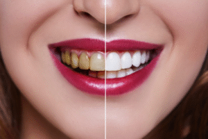 Read more about the article Porcelain vs. Composite Veneers: Pros & Cons