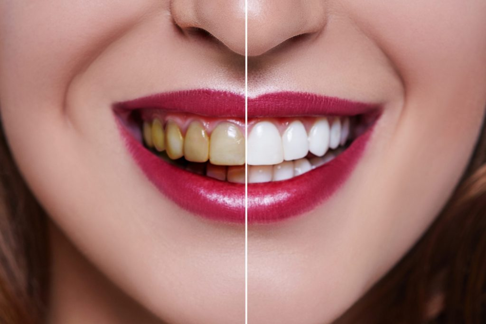 You are currently viewing Porcelain vs. Composite Veneers: Pros & Cons