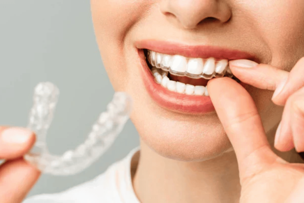 You are currently viewing Clear Aligners for Professionals: Stealth Straightening