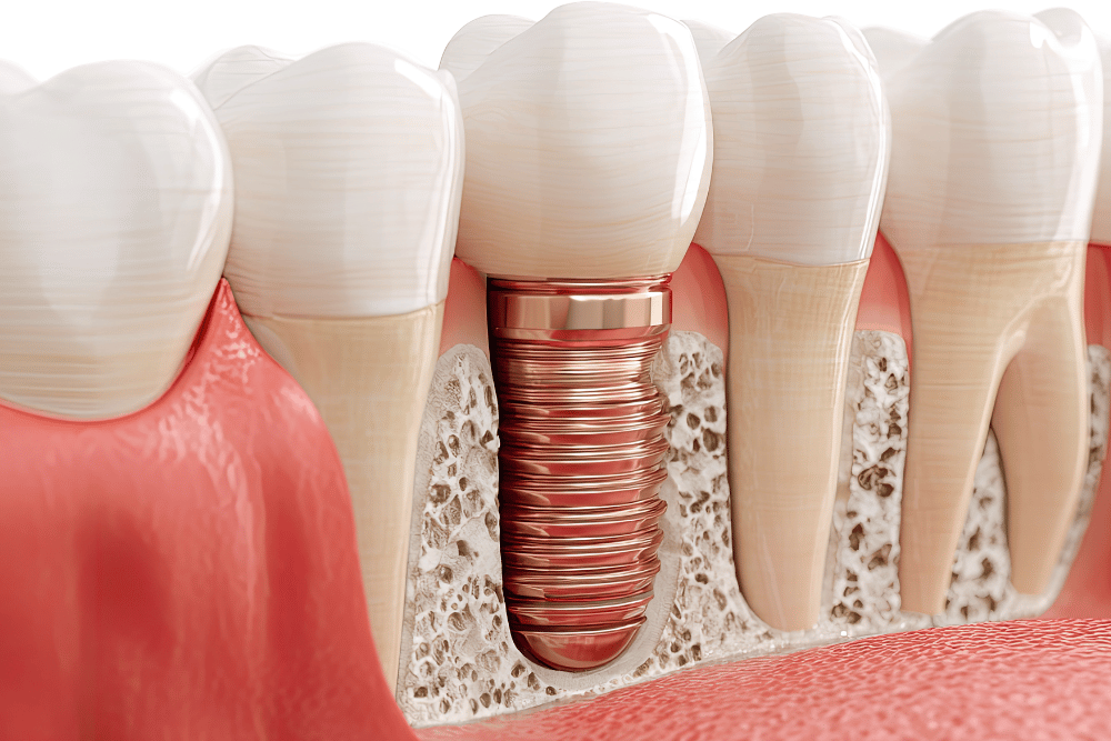 Bone Grafting: Building the Foundation for Your New Smile