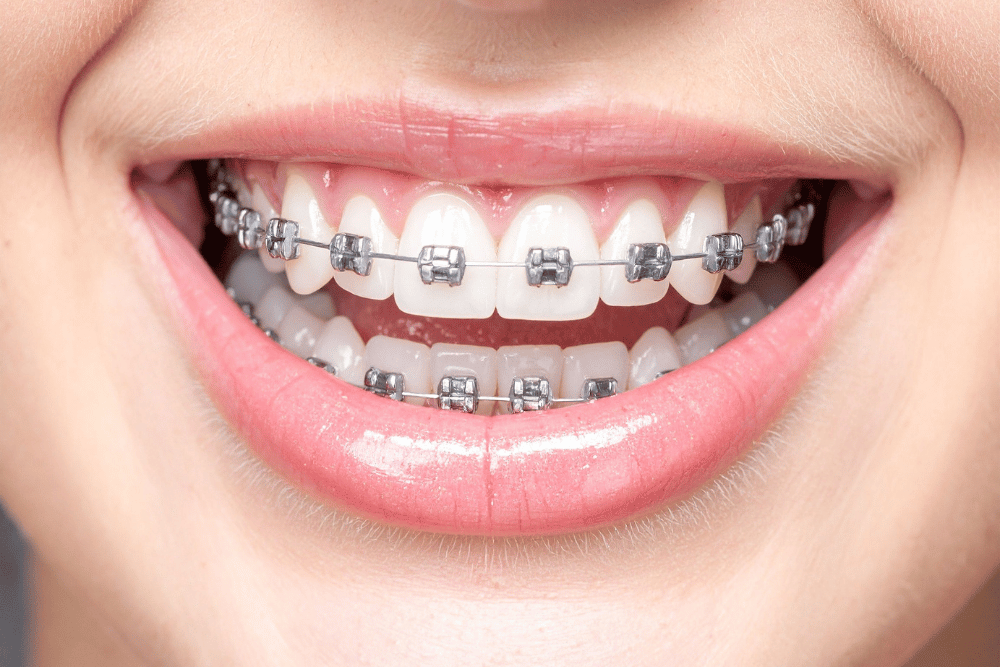 Braces vs. Invisalign: Choosing the Right Path to Your New Smile