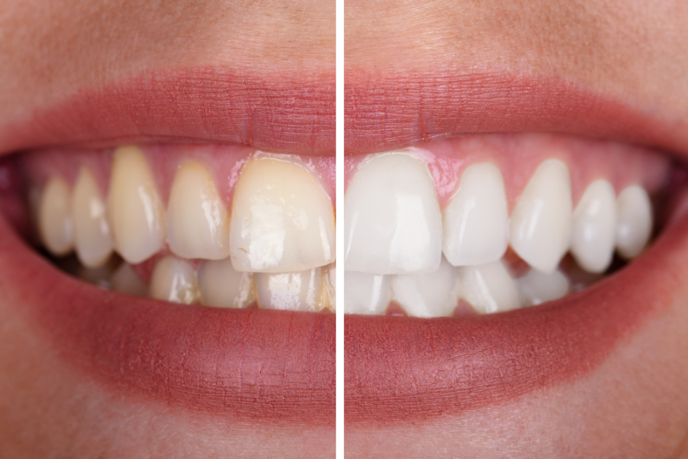 Full-Mouth Reconstruction: A New Lease on Life for Your Smile