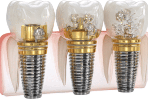 Read more about the article Bridging the Gap: How Dental Bridges Restore Your Smile