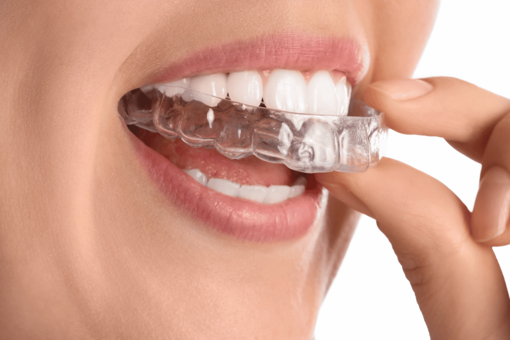 You are currently viewing Smile Through Your Treatment: The Lifestyle Benefits of Clear Aligners