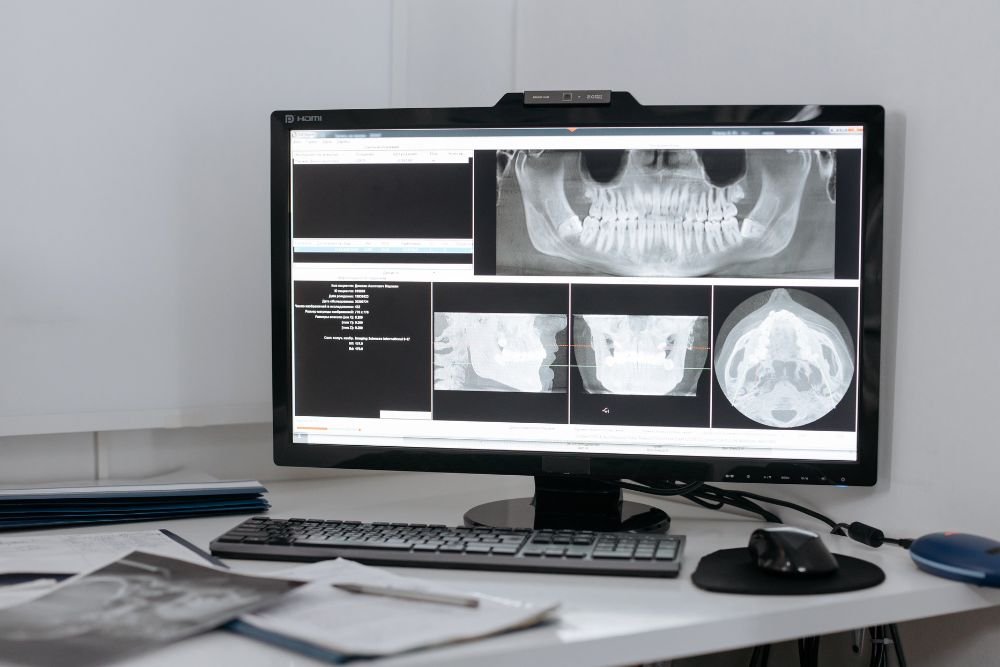 Do I Really Need My Wisdom Teeth Removed? The Proactive Approach
