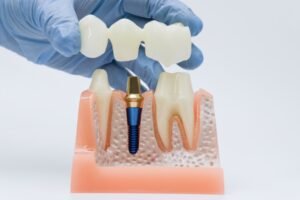 Read more about the article Dental Crowns: The “Helmet” Your Tooth Needs