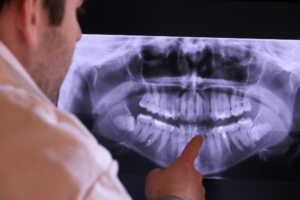 Read more about the article When is an Extraction Necessary? Saving Your Overall Health