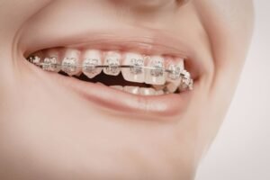 Read more about the article Traditional Metal Braces: The Tried-and-True Way to a Perfect Smile