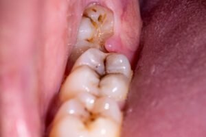 Read more about the article Invisible Armor: How Dental Sealants Protect Your Child’s Smile