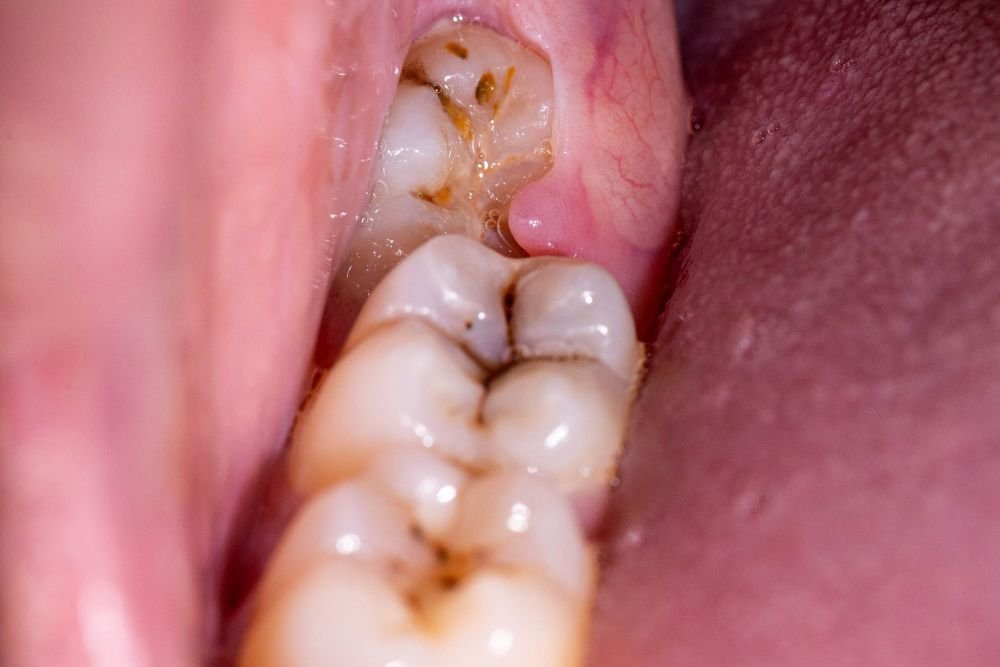 Invisible Armor: How Dental Sealants Protect Your Child’s Smile