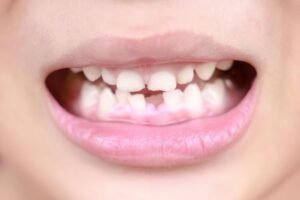 Read more about the article Hidden Consequences: Why You Shouldn’t Leave a Missing Tooth Untreated