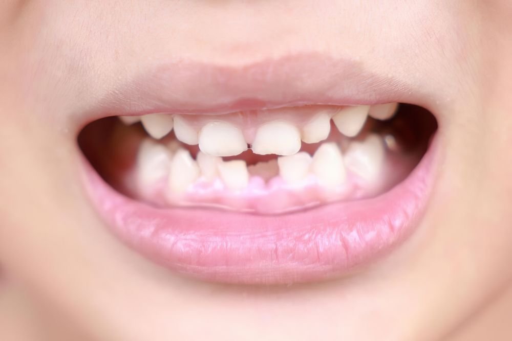 Hidden Consequences: Why You Shouldn’t Leave a Missing Tooth Untreated