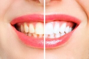 Read more about the article Instant Transformation: How Porcelain Veneers Create Perfect Smiles