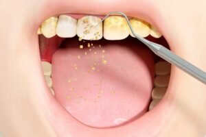 Read more about the article Plaque vs. Tartar: What Are They, and Why Should You Care?