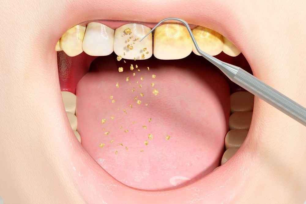 Plaque vs. Tartar: What Are They, and Why Should You Care?