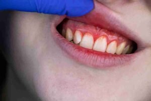 Read more about the article The Progressive Timeline: Understanding the Stages of Gum Disease