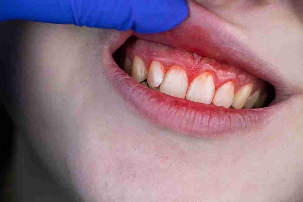 The Progressive Timeline: Understanding the Stages of Gum Disease